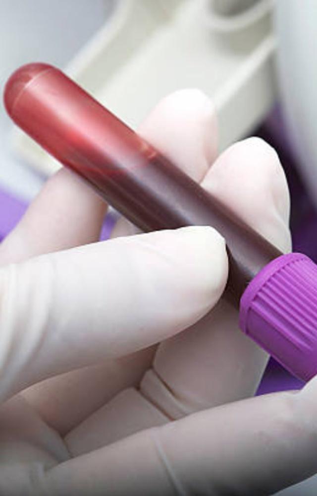 Haemoglobin levels of more than 16.5g/dL in males and 16g/dL in females is considered abnormal 
