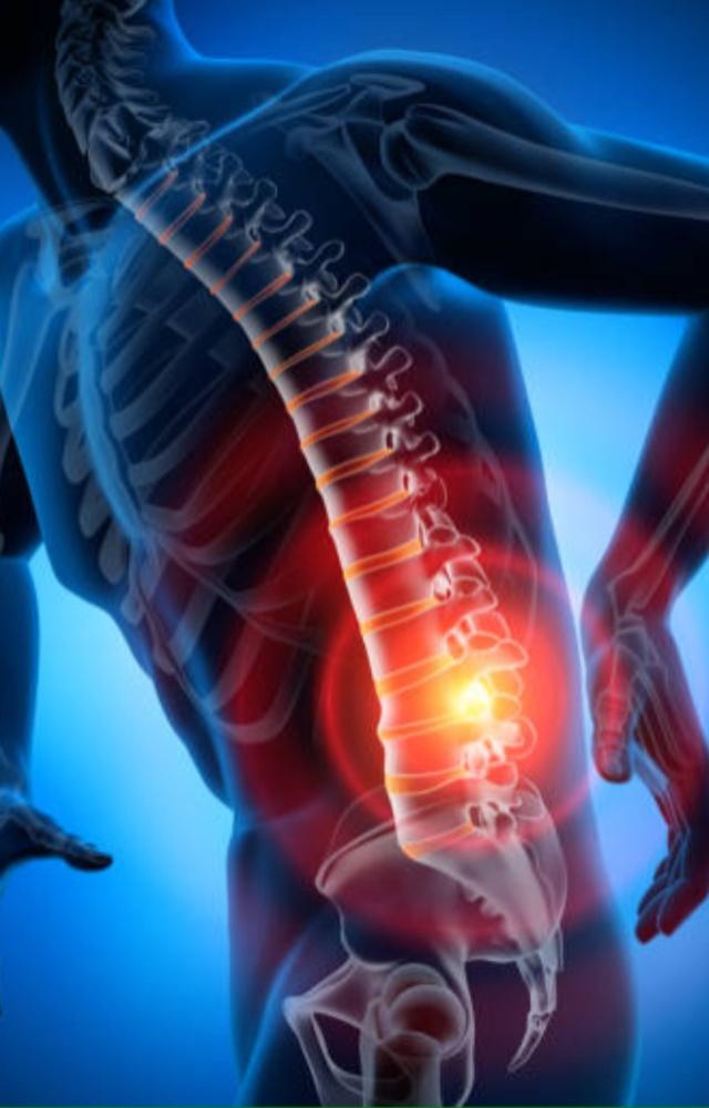 This occurs when the inner gel-like material of a spinal disc leaks through a tear in the disc`s outer layer. This causes pain numbness or weakness in the limbs