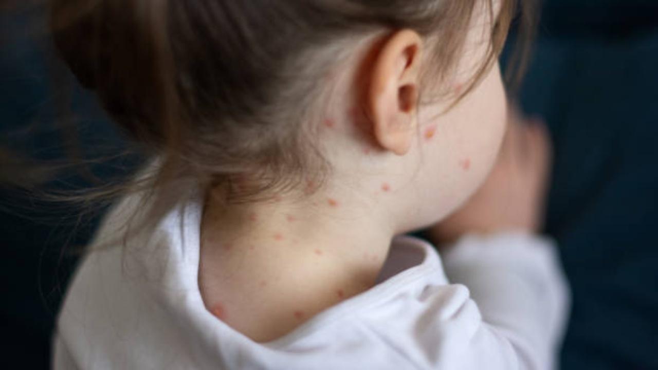 Over one million Indian children missed measles vaccine in 2022: WHO