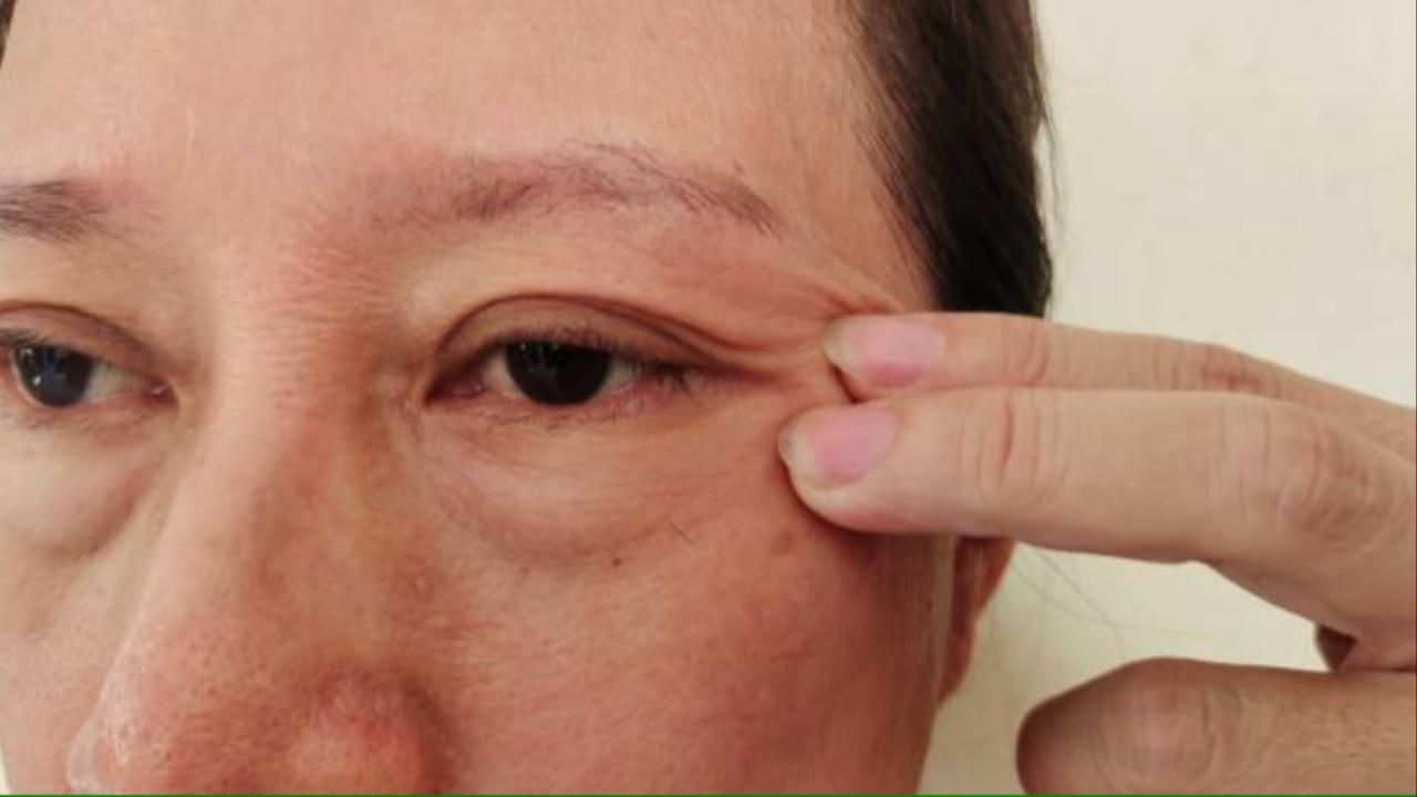 All you need to know about the eye condition causing a drooping upper eyelid