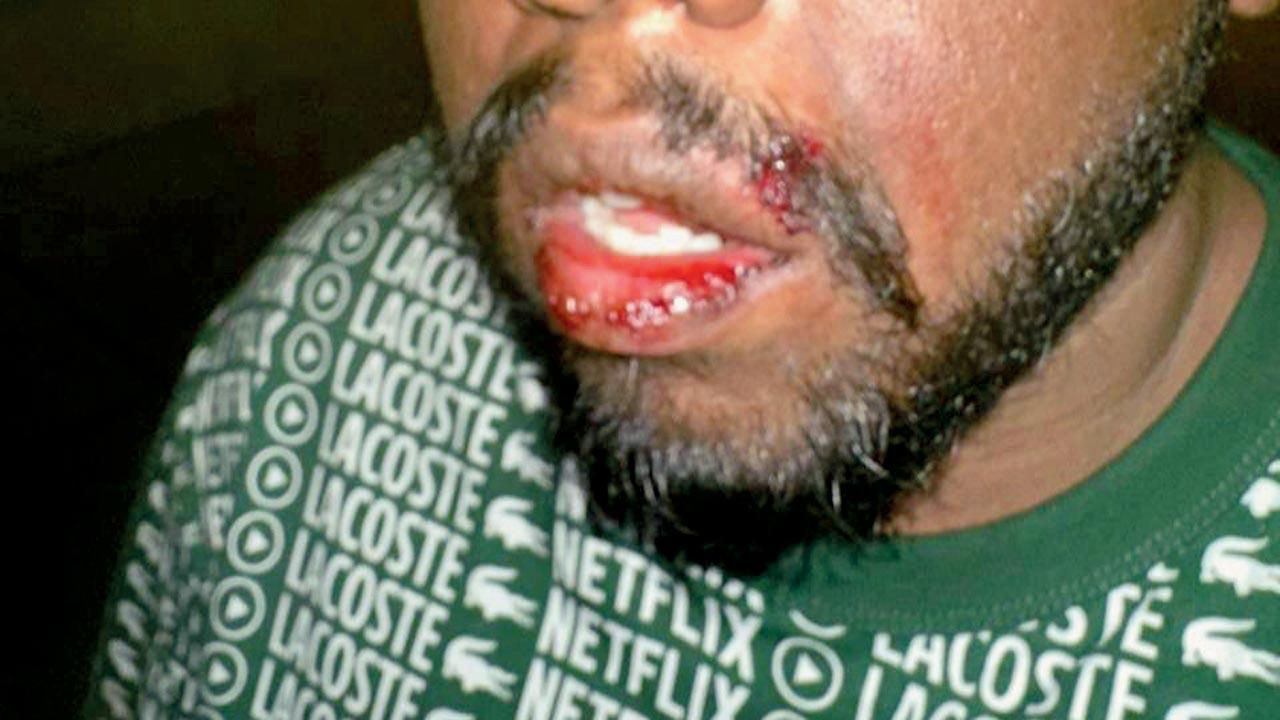 An Indian from Mumbai who sustained an injury to his lips