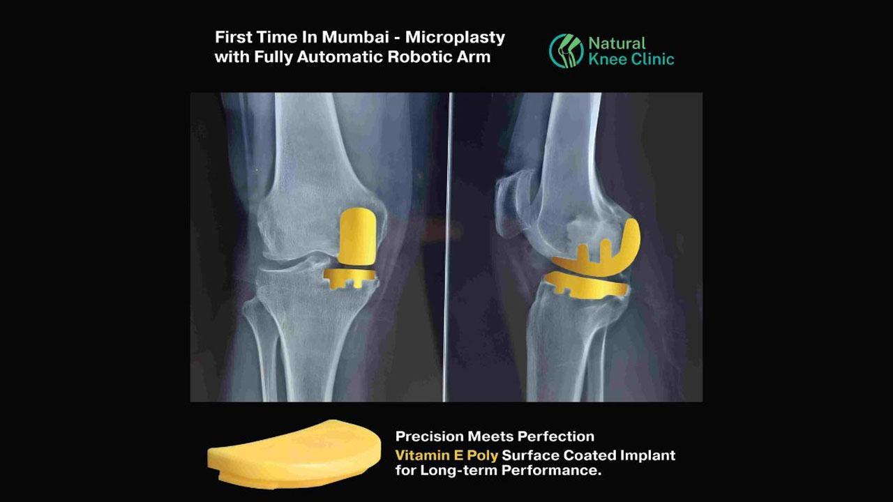 Medical Breakthrough At Criticare Asia Hospital Preserves Your Natural Knee with Absolute Precision Robotic Microplasty Surgical Technique.