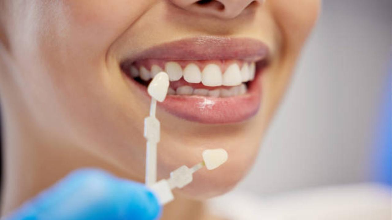 Veneers vs cosmetic options: How to improve the appearance of your teeth?