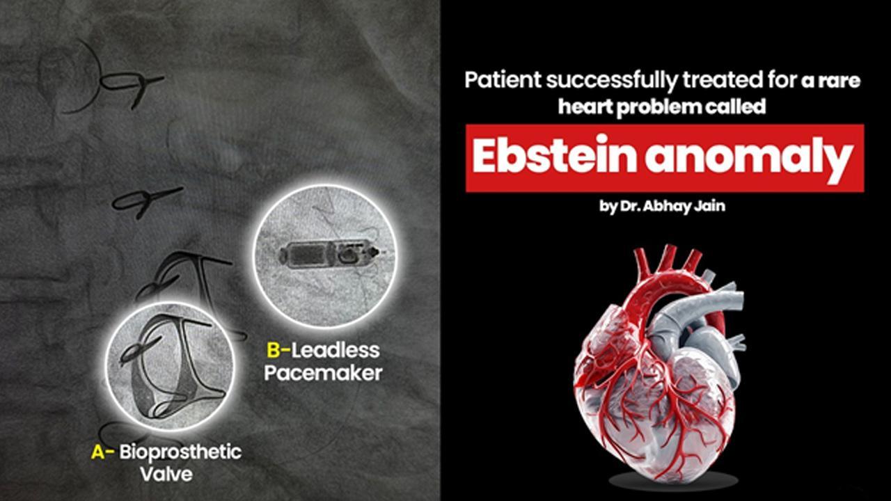 Patient Successfully Treated For A Rare Heart Problem Called Ebstein Anomaly By Dr. Abhay Jain
