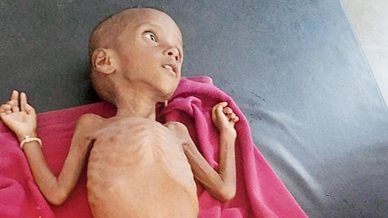 SAM in children across tribal regions has been increasing for three years, most acutely in Nandurbar district. Pics/Hanif Patel
