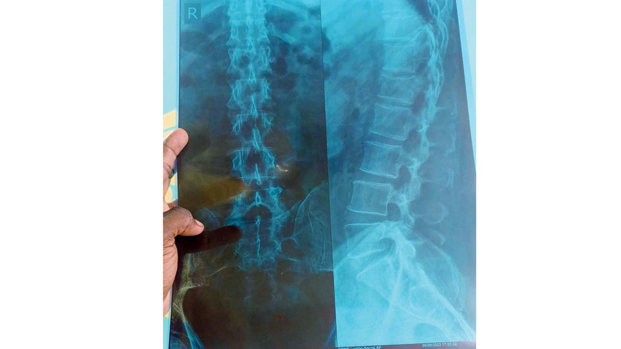 An X-ray of K Subharaman’s spine