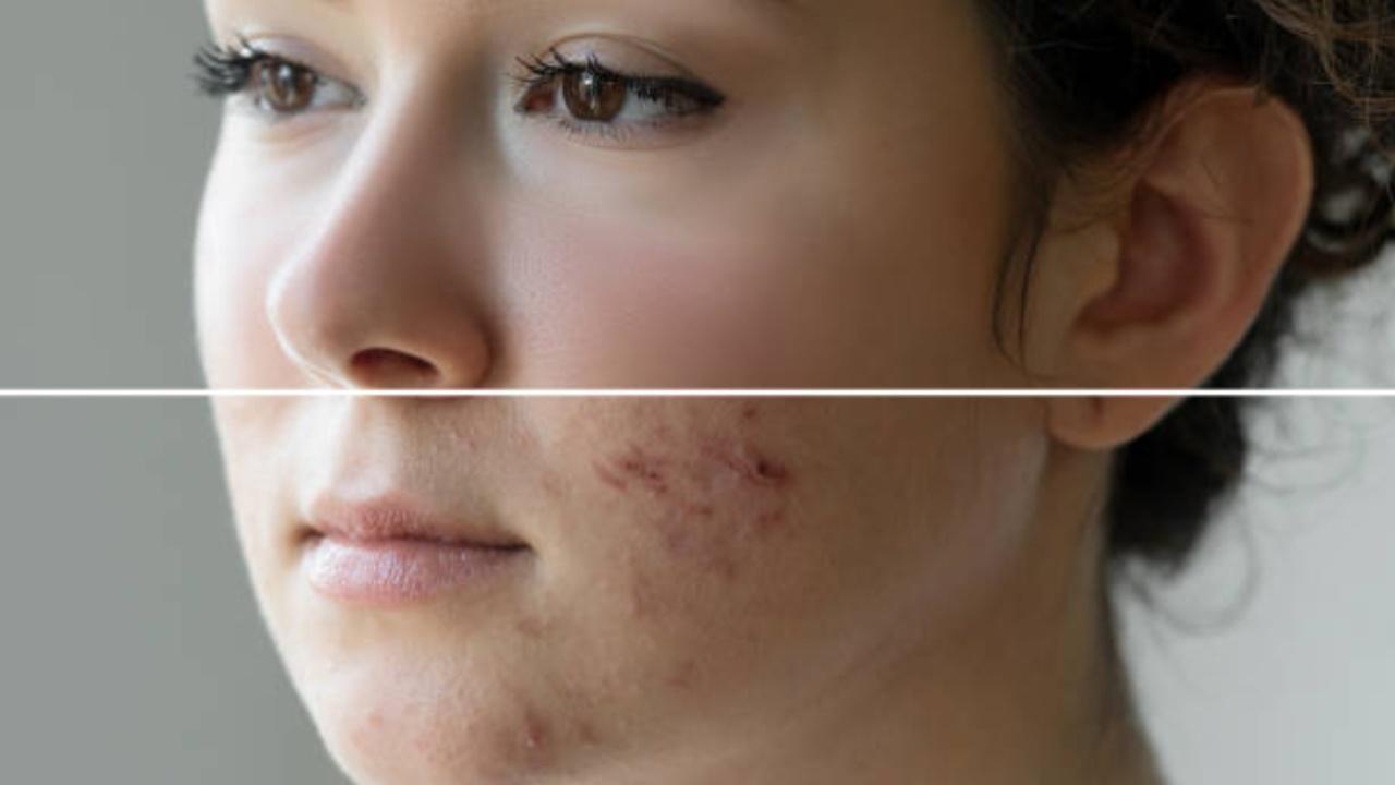 Four common cosmetic treatments to get rid of acne scars
