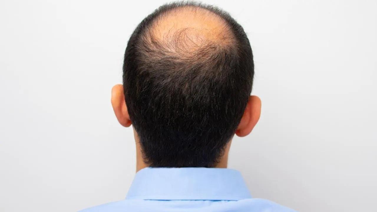 Researchers identify rare gene variants causing hereditary hair loss in men