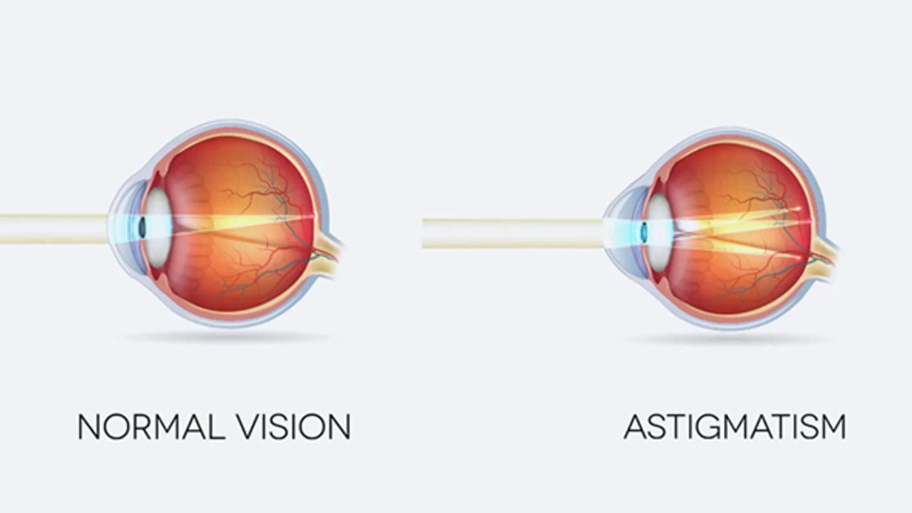 Astigmatism: A Comprehensive Guide to Treating Your Eyes