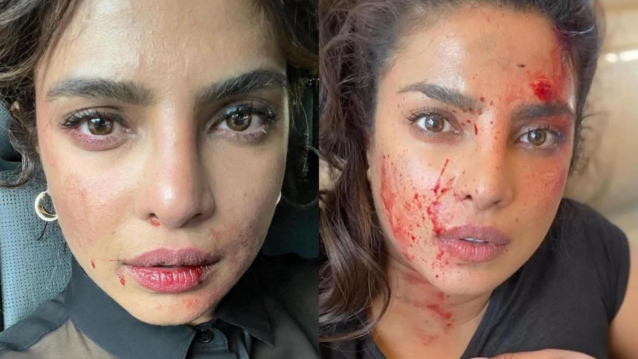 Priyanka Chopra shares photo of bloodied forehead from 'Heads of State' set