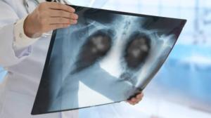 Increasing number of women are falling victim to lung cancer: Doctors