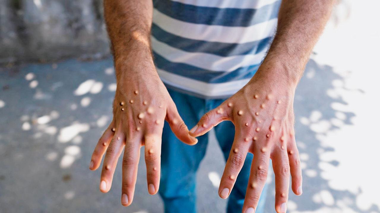 Pakistan confirms case of new mpox variant