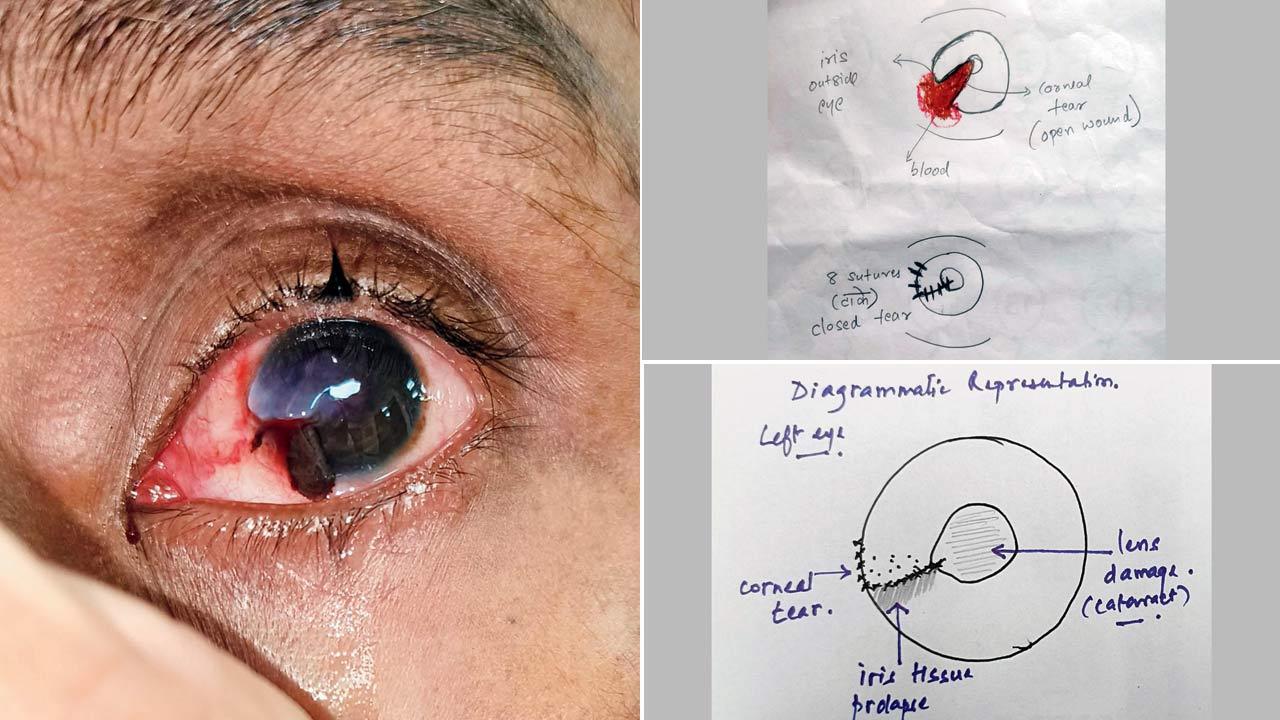 Mumbai: Rajawadi doctors save man’s eye pierced by stray nail