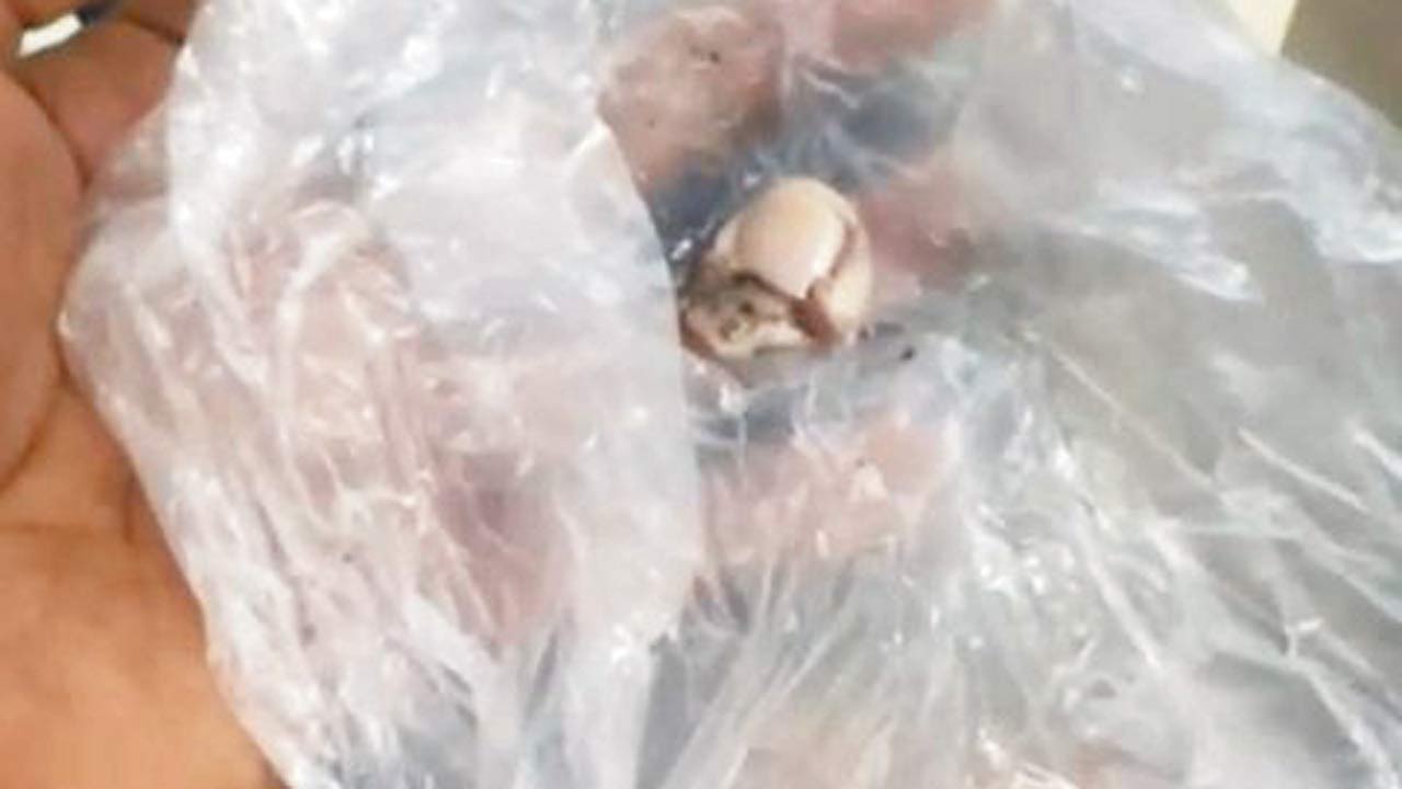 The top part of Desai’s thumb that was bitten off