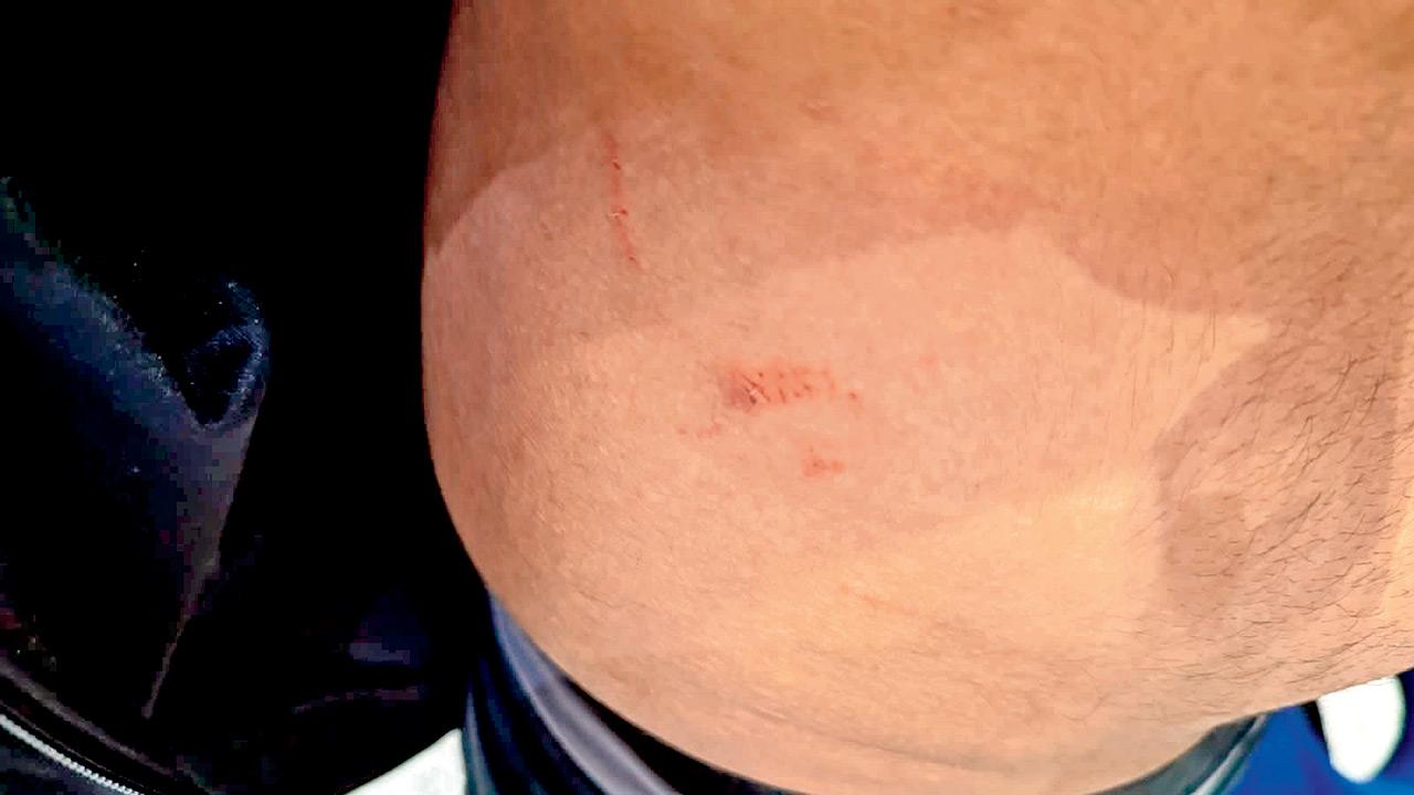 Injury marks allegedly sustained from the assault