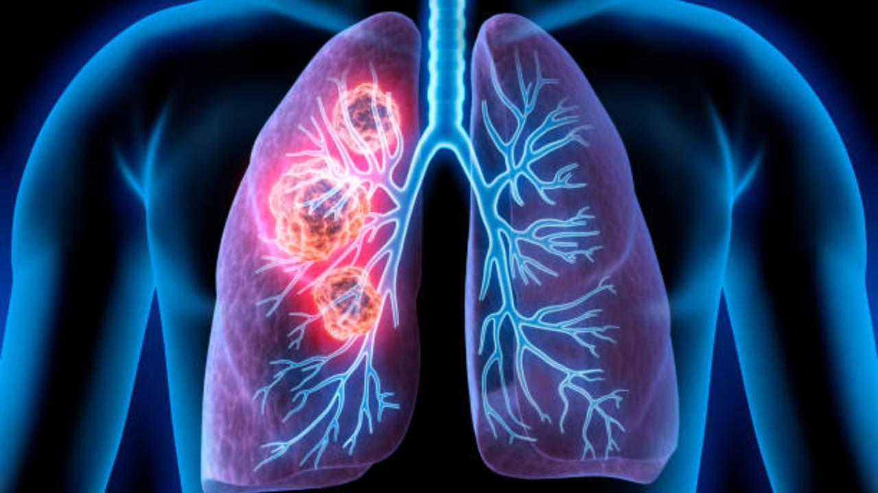 Common fungal infection may prove deadly in lung disease patients, finds AIIMS study