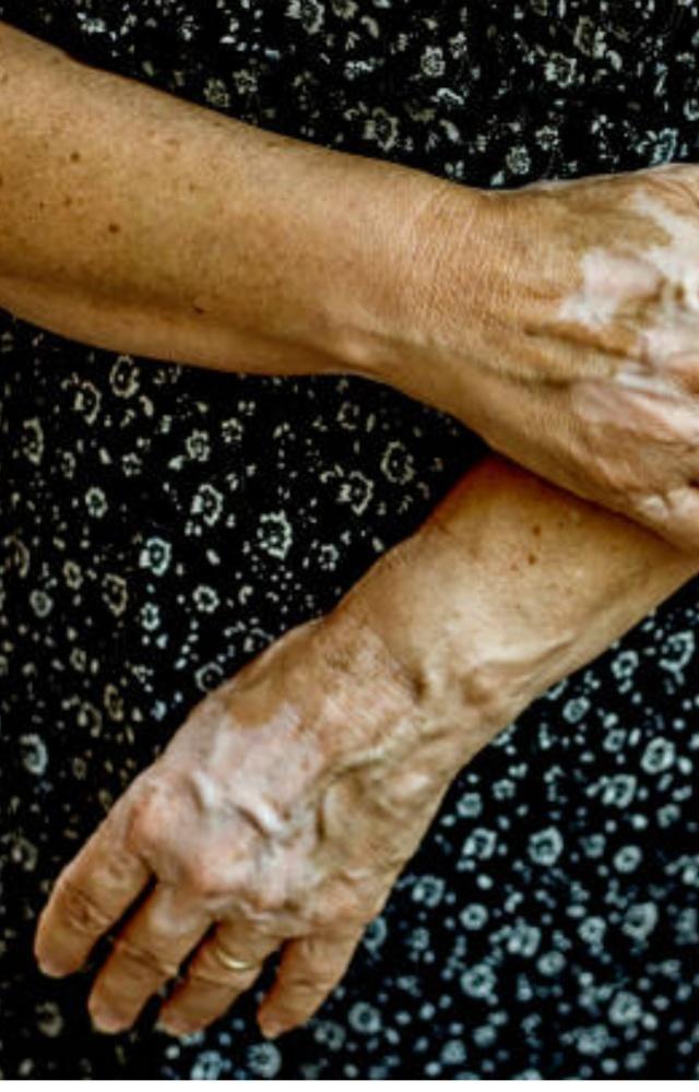 Autoimmune diseases: 5 common symptoms