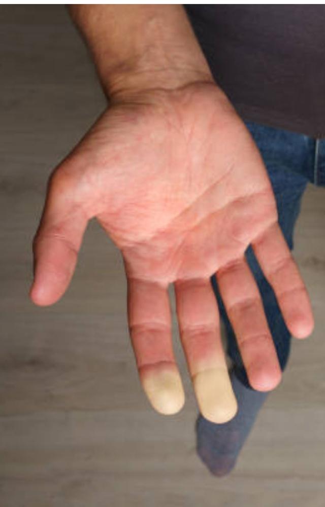 Raynaud`s phenomenon is characterised by the fingertips turning blue or white upon exposure to cold temperatures or stress 
