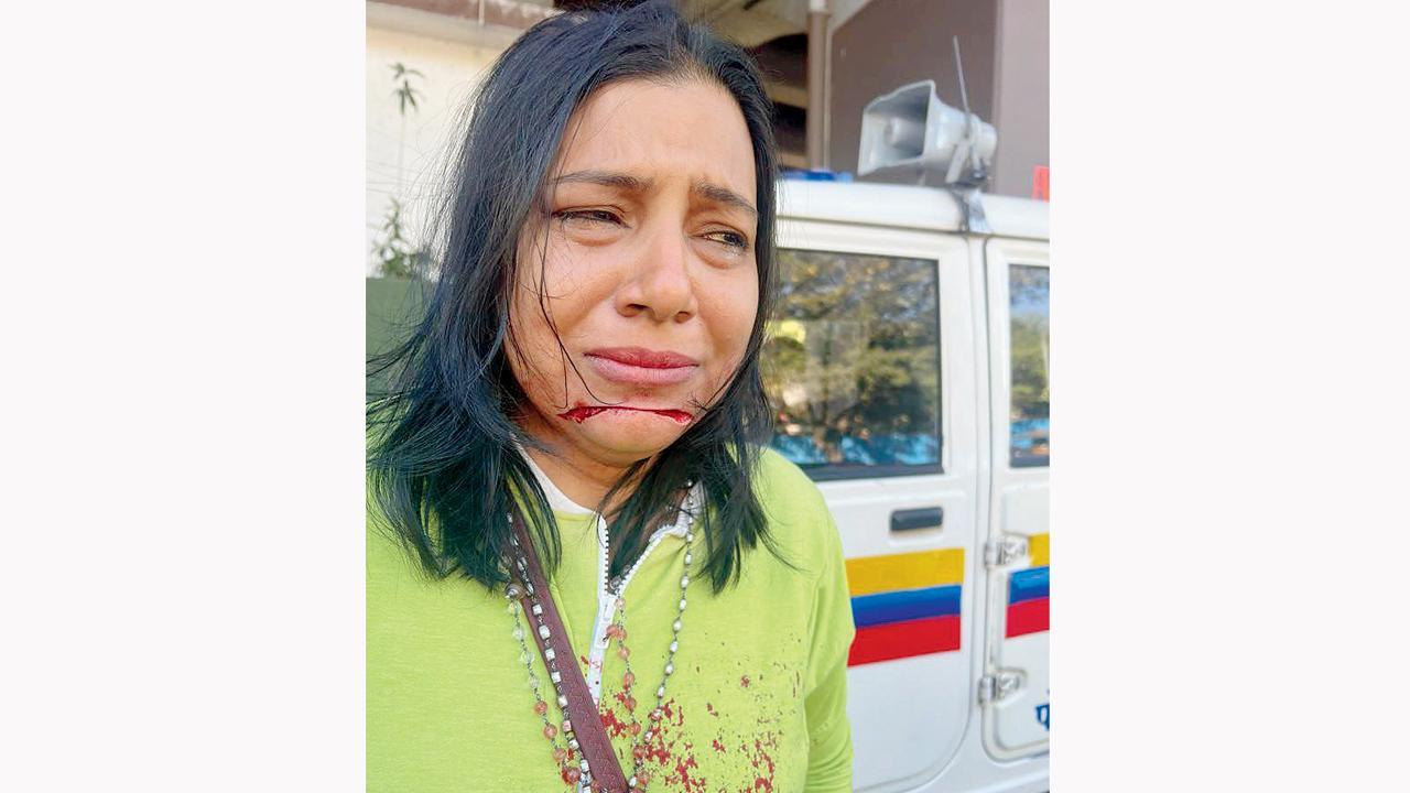 Mumbai: Manja slashes woman’s entire chin