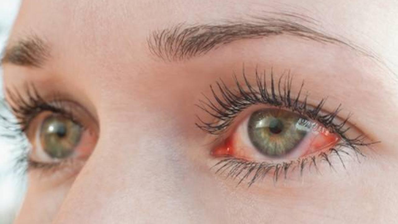 Blood flow changes in eyes may affect visual symptoms of migraines: Study