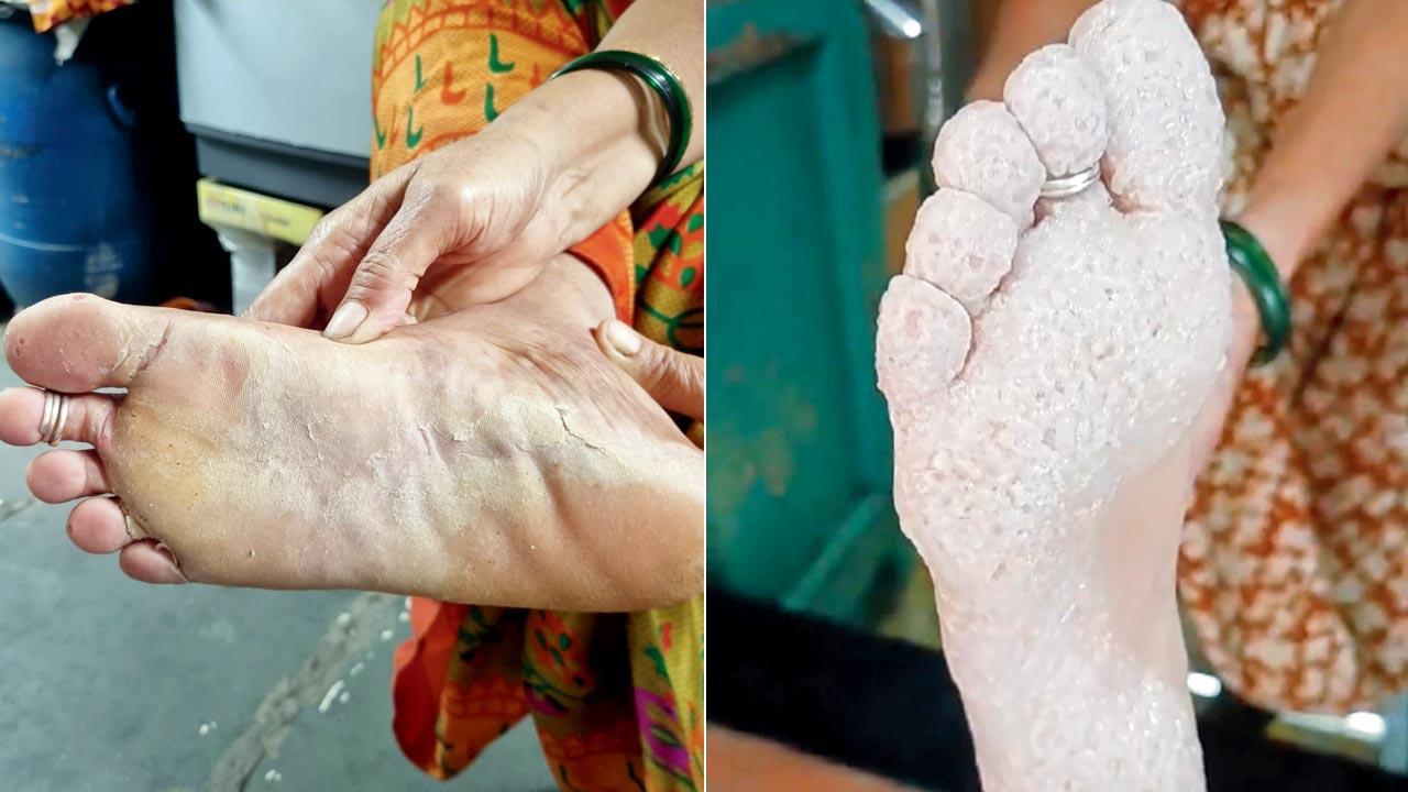 Mumbai: Foot infections plague Swadeshi Mill chawl residents in Kurla