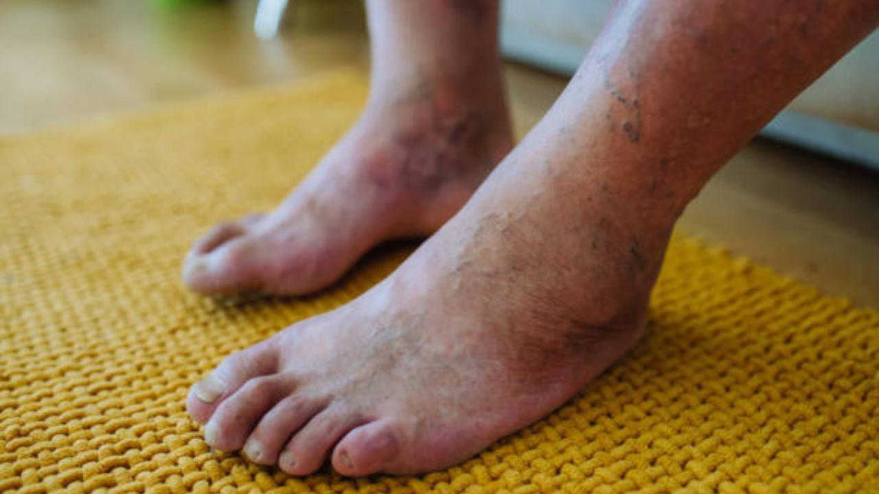 Monsoon likely to trigger foot ulcers in diabetic patients: Experts