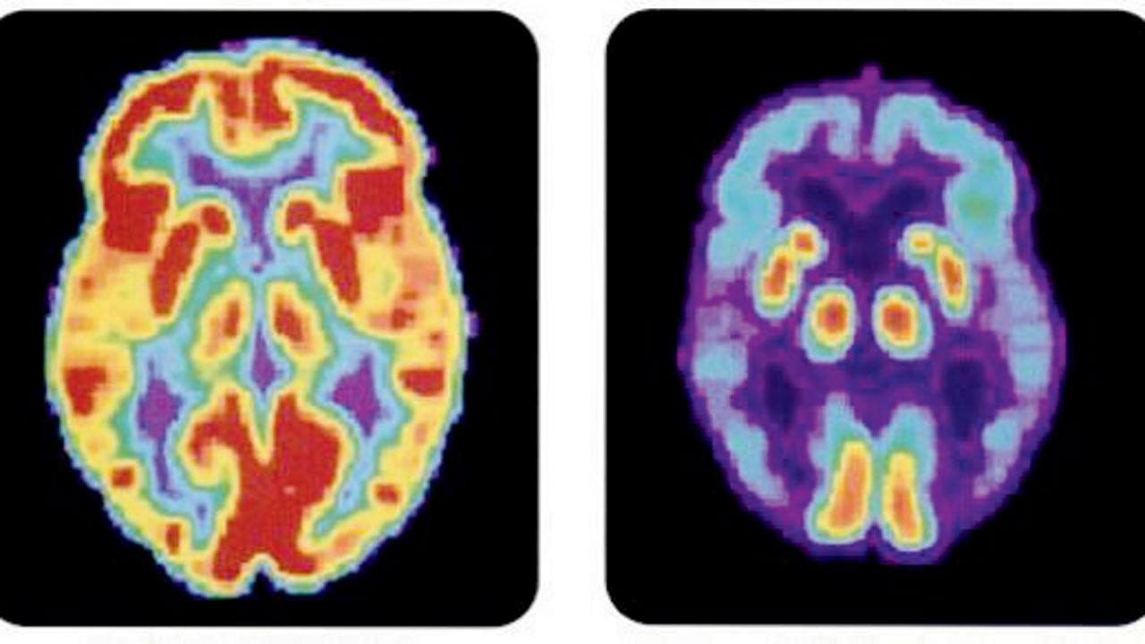 Alzheimer’s drug that can slow disease gets backing from FDA