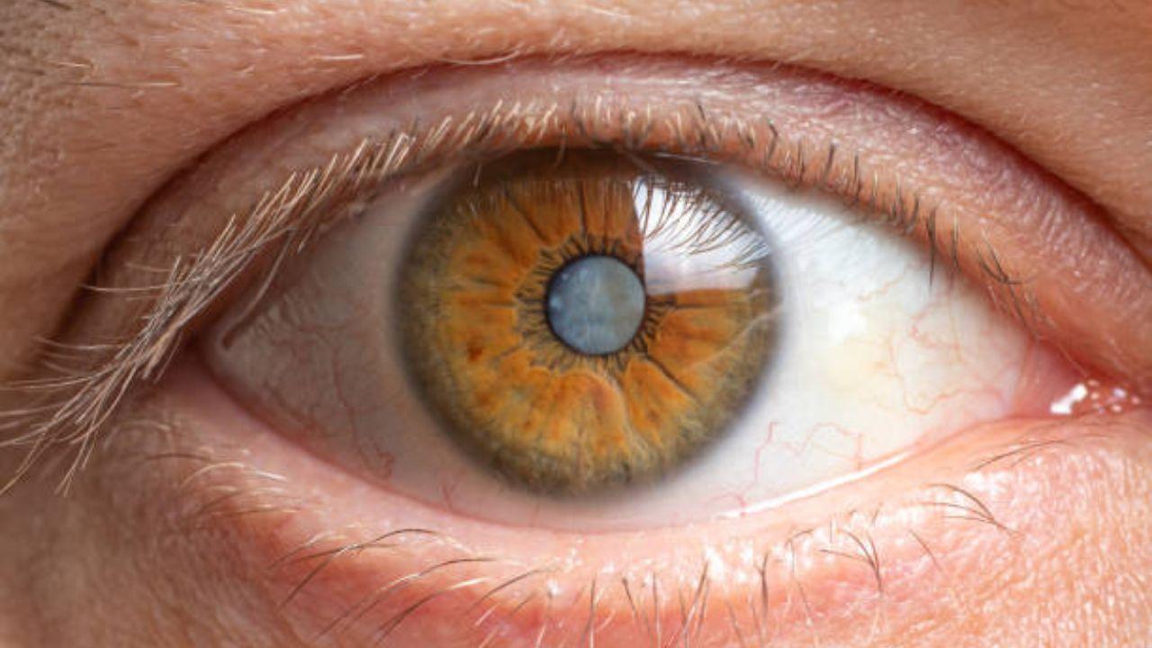 Have diabetes? Doctor shares tips to reduce the risk of cataracts 