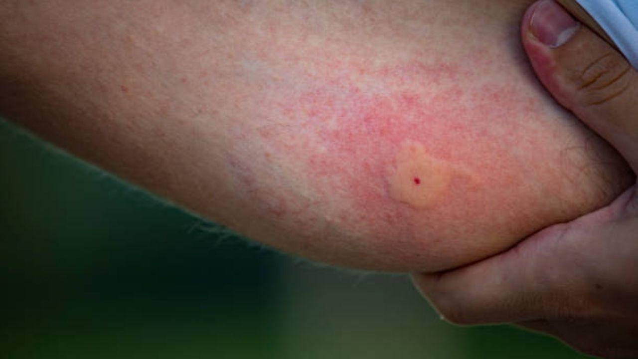 Limit going outdoors during the night or in unhygienic surroundings to reduce the chances of getting bitten by mosquitoes which can cause malaria and dengue. Use insect repellents on your clothes, hats, and socks to shield yourself from harmful mosquitoes.  