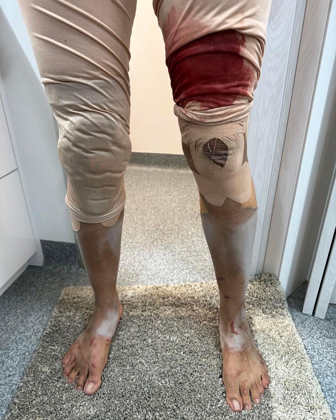 Priyanka's blood-filled leg left fans concerned. In another video, she had blood all over her face and shoulder. 