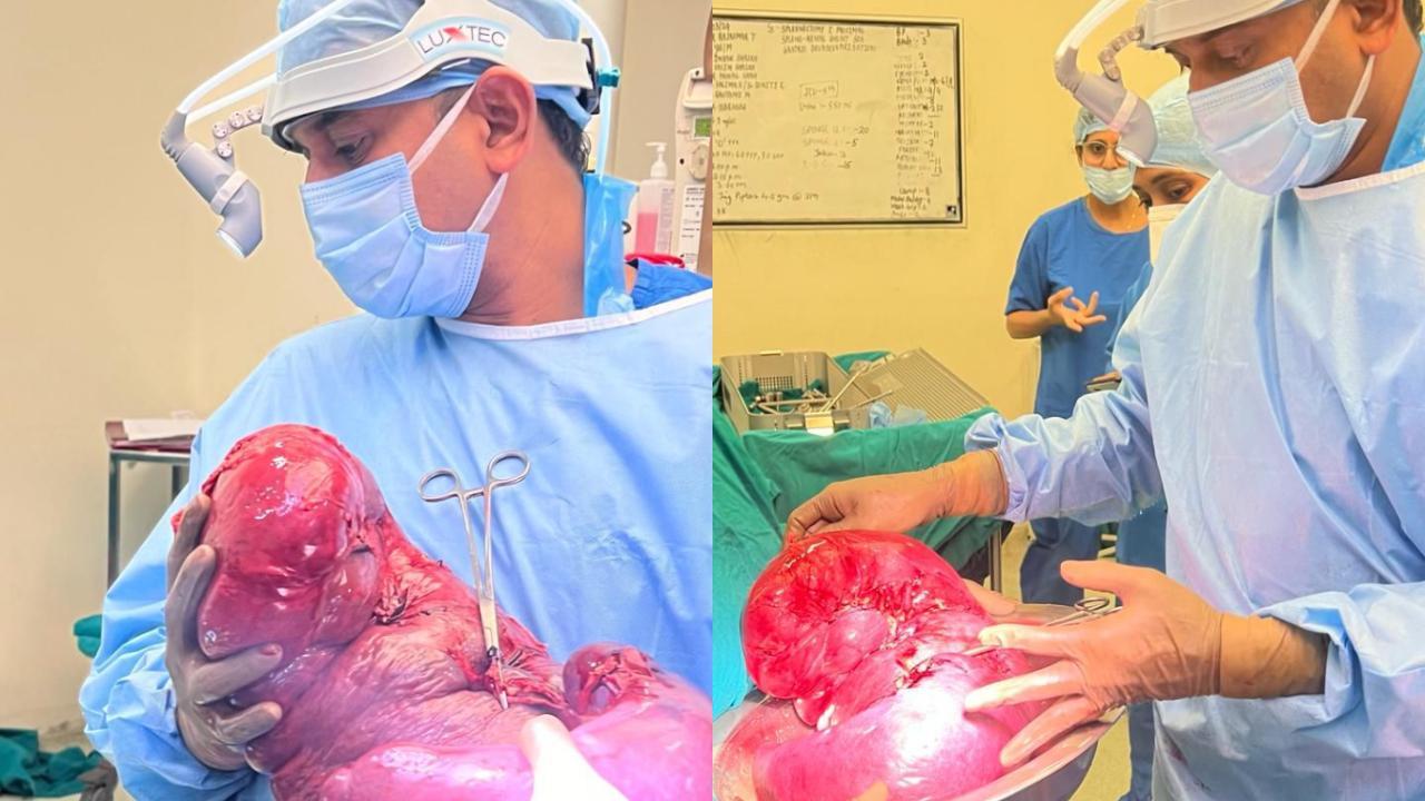 World’s first giant 8.5 Kg spleen removed from man’s abdomen