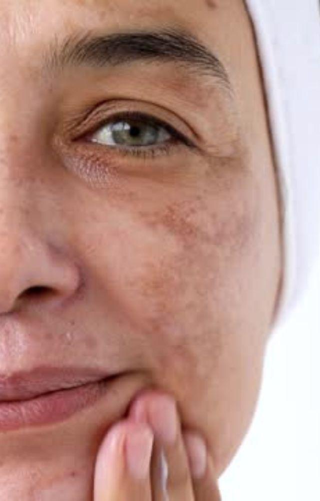 Hyperpigmentation: 4 homemade face packs