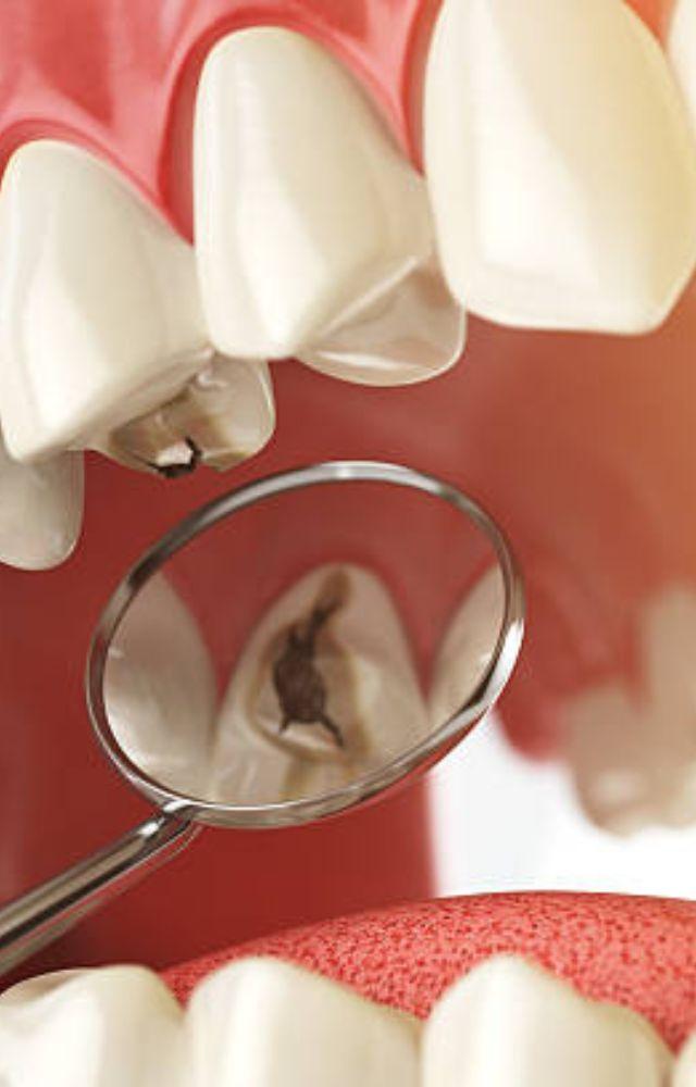 Cavities can develop when plaque, a sticky film of bacteria, accumulates on teeth and produces acid, eroding tooth enamel
