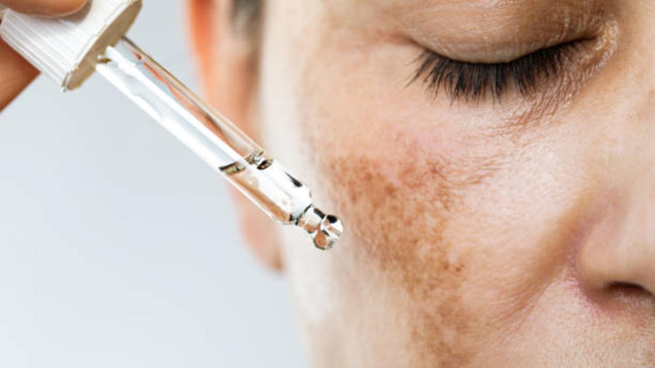 City residents more prone to hyperpigmentation: Experts recommend home remedies