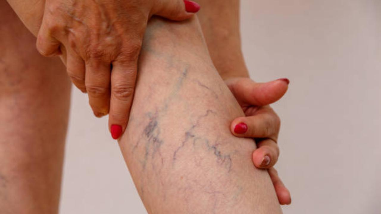 All you need to know about varicose veins and its impact on health