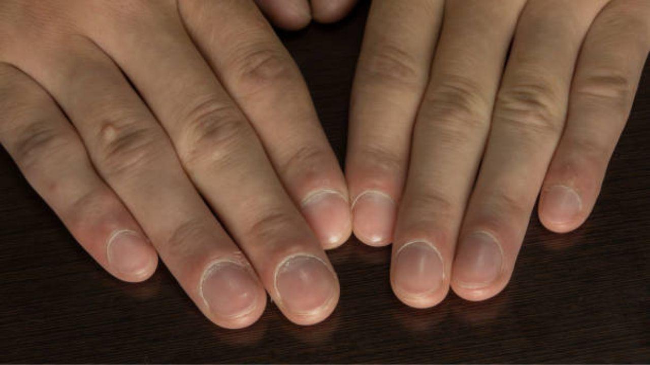 Your nail colour can signal cancer risk: Study
