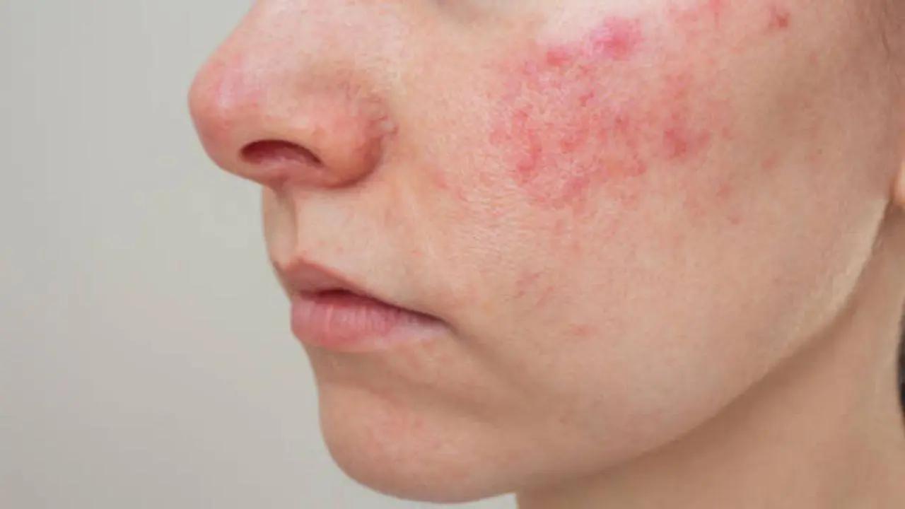People with lupus are more susceptible to infection, cancer, and bone tissue death, since the disease and its therapies can impair the immune system. Lupus also raises complications in pregnancy problems. Read more