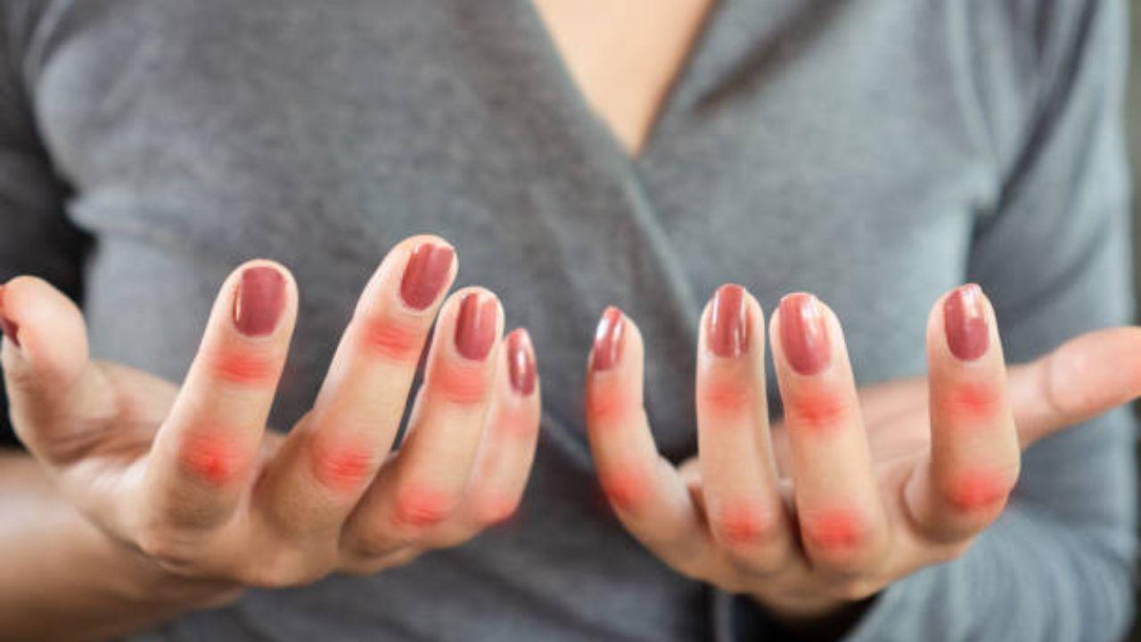 Lupus affects millions of individuals worldwide. In India, 3.2 cases of lupus are documented per 100,000 people. However, globally women in the reproductive age range disproportionately account for up to 90 per cent of cases.  