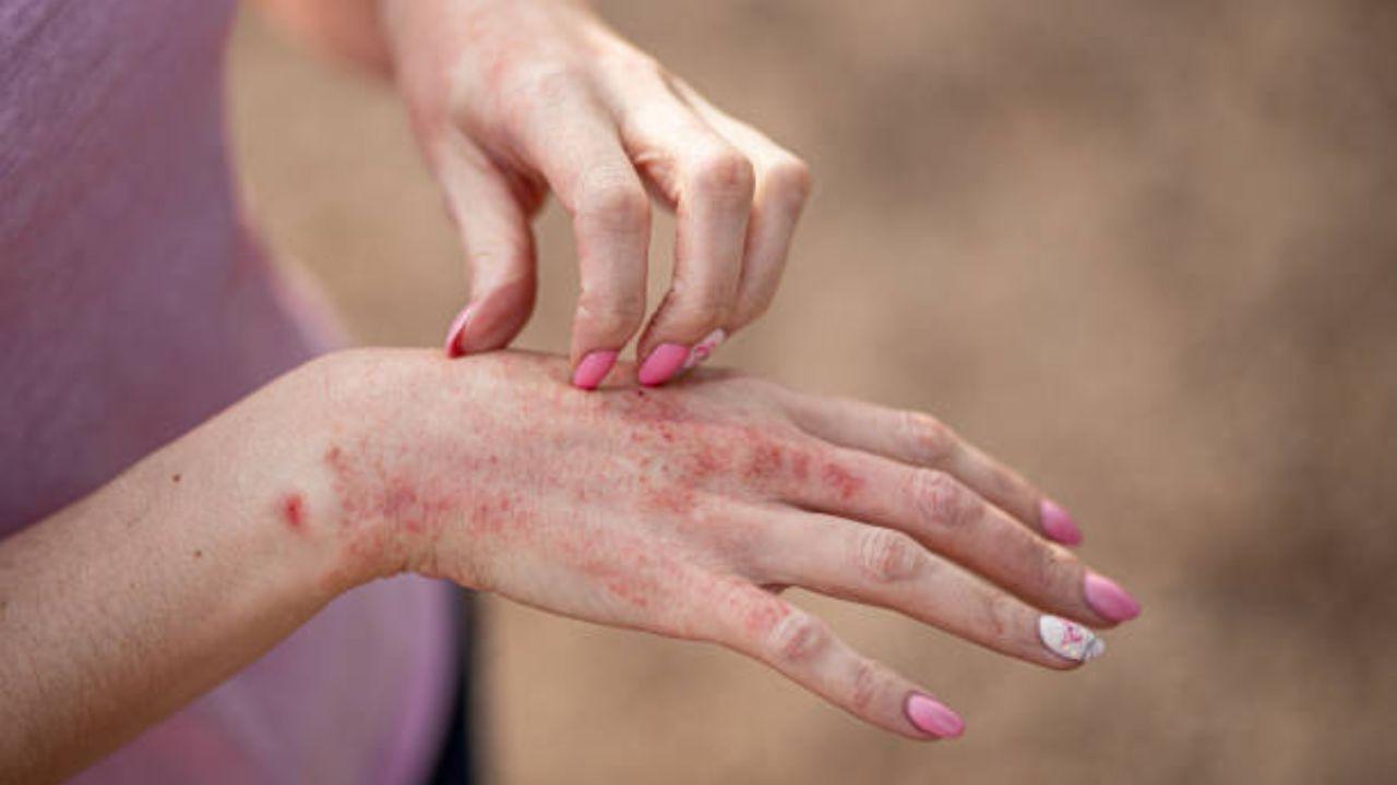 Physical activity may be key to managing the autoimmune disorder, and the associated problems as well as ease mental stress. 
With inputs from IANS. Read more here