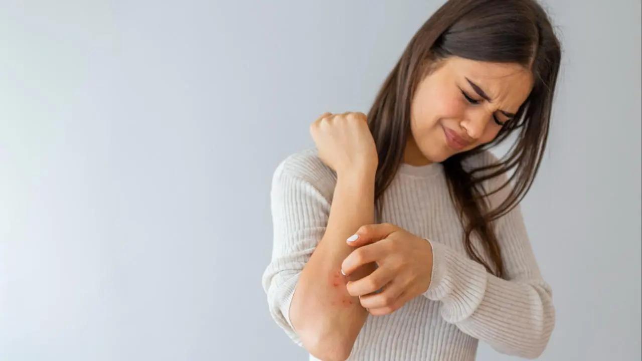 10-20 per cent women may experience psoriasis during pregnancy, finds study