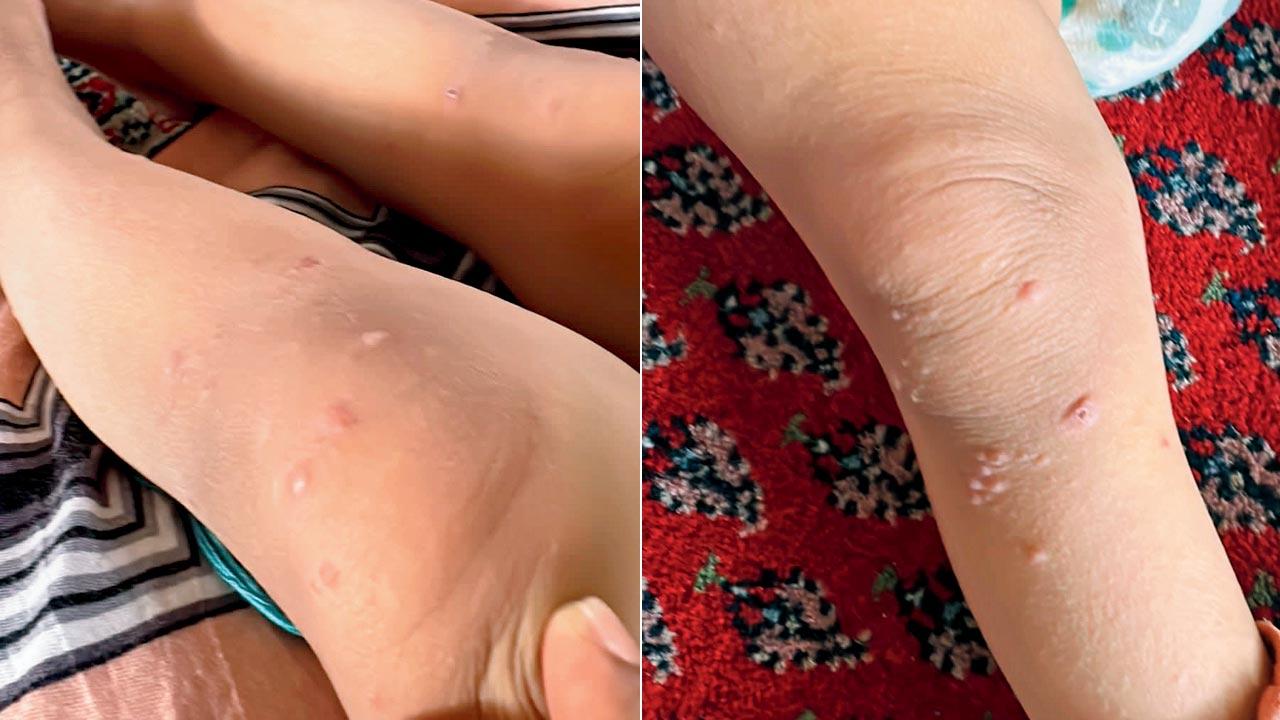 The virus also caused severe dehydration; (right) The infection usually disappears in a week
