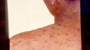 Experts hail indigenous test kit for monkeypox