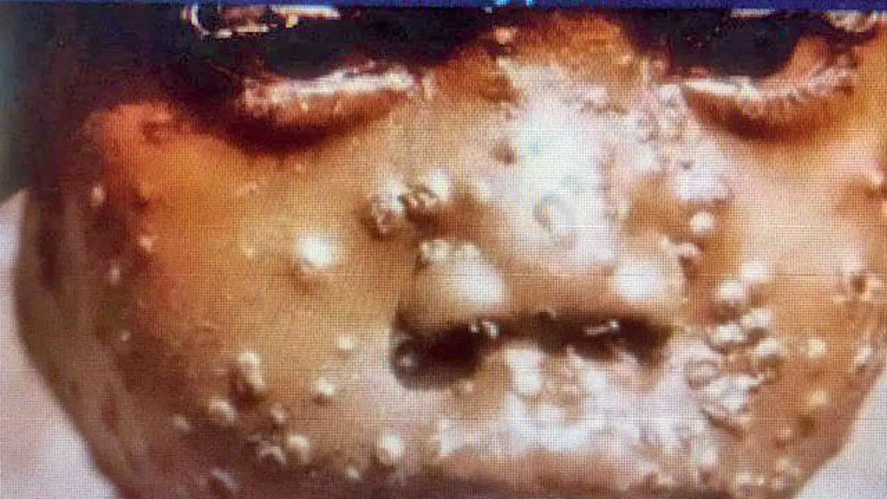 Mpox deaths rise by 107 in one week as Africa CDC calls toll unacceptable