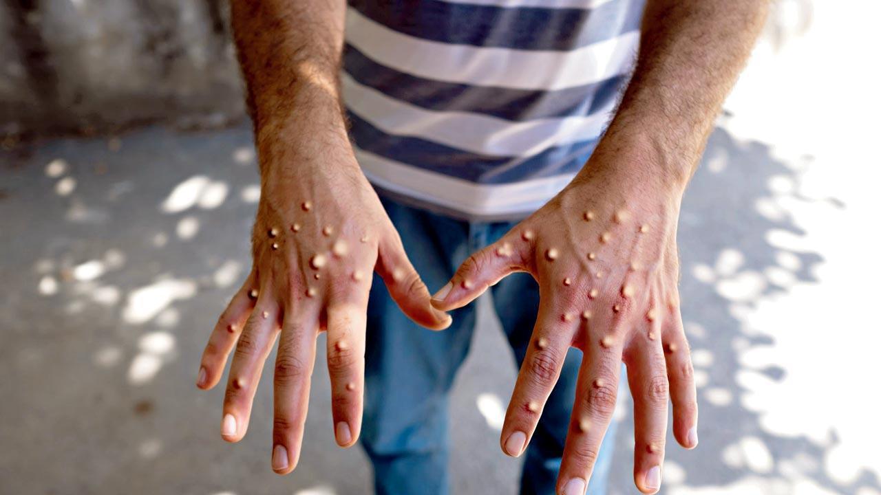 Are mpox cases under-reported?