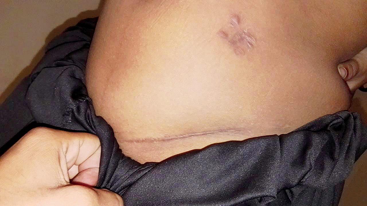 The surgical scar of the woman who was promised R5 lakh for her kidney