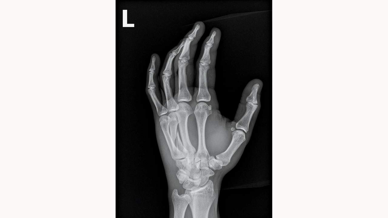 The x-ray that shows a fracture on the fourth metacarpal in Neeraj Chopra’s left hand