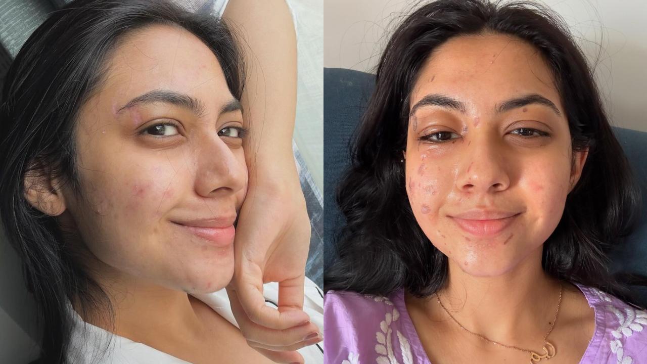 Reem Shaikh shares health update after burn injury on Laughter Chefs