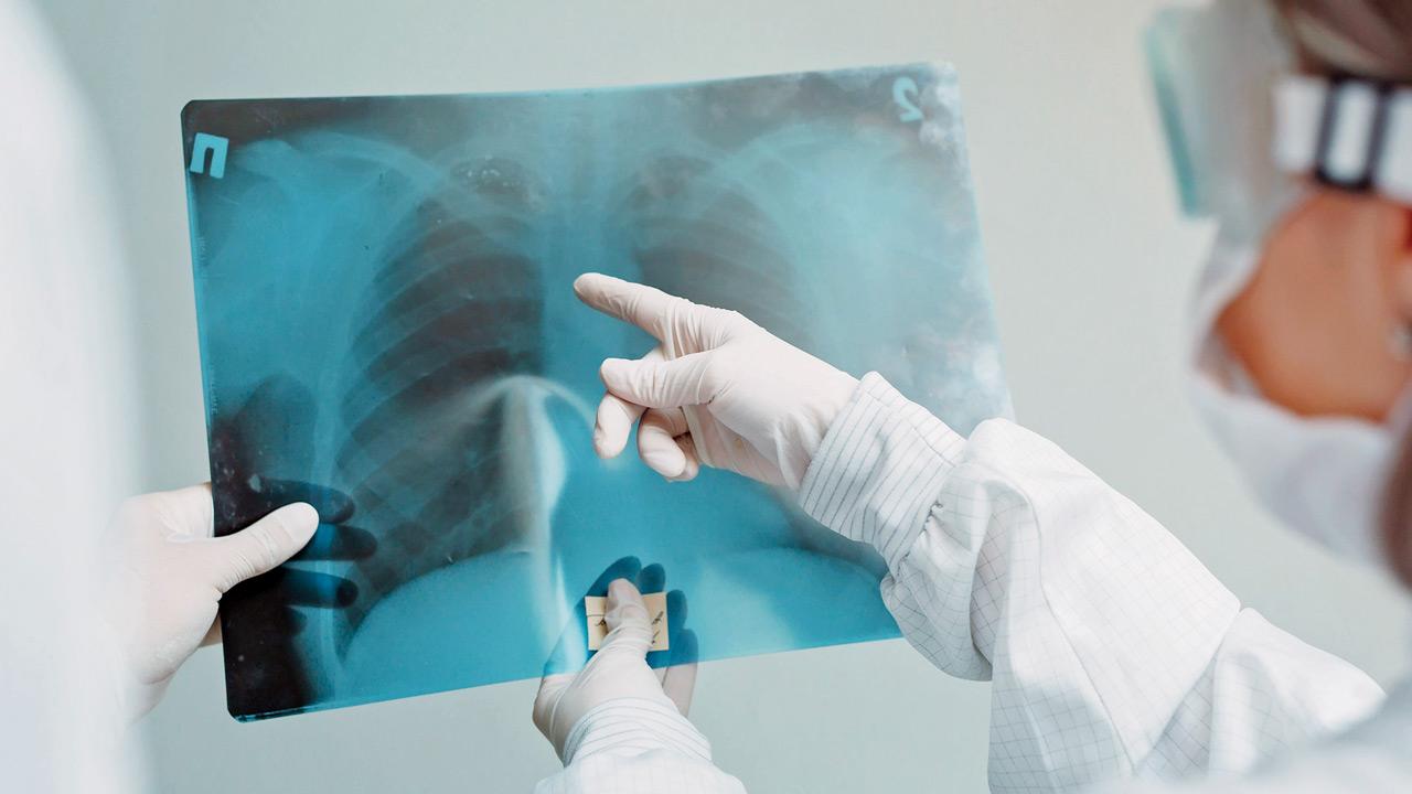 Mumbai: Worrying rise in non-respiratory TB, say doctors