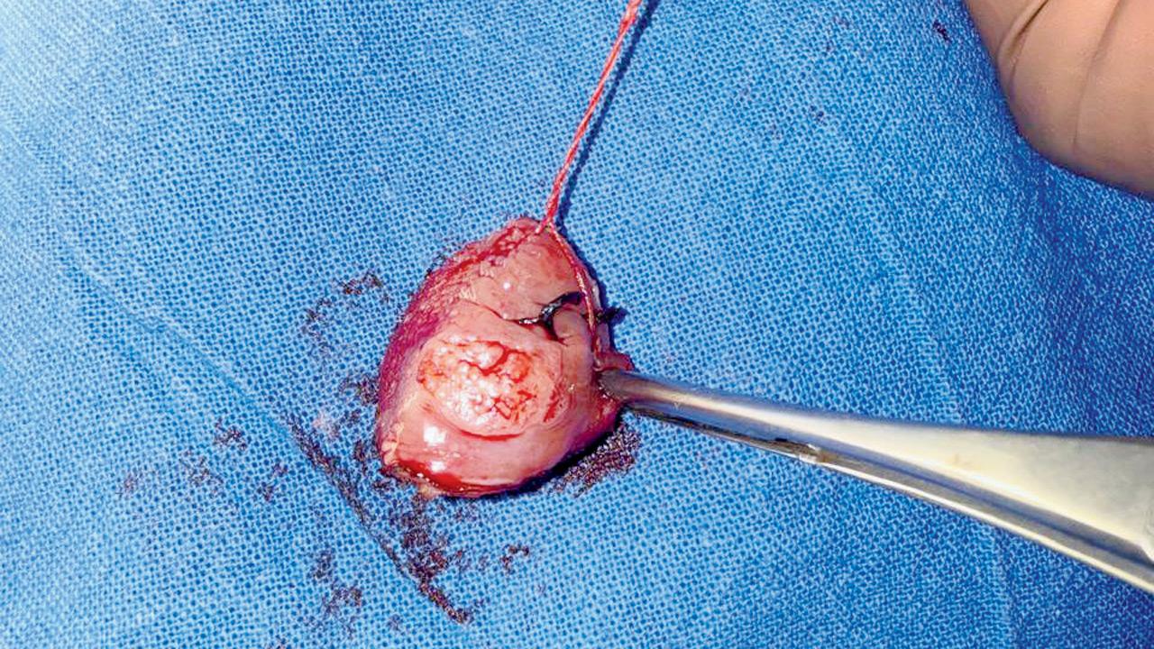 The ulcer that was removed from Ayaansh’s mouth