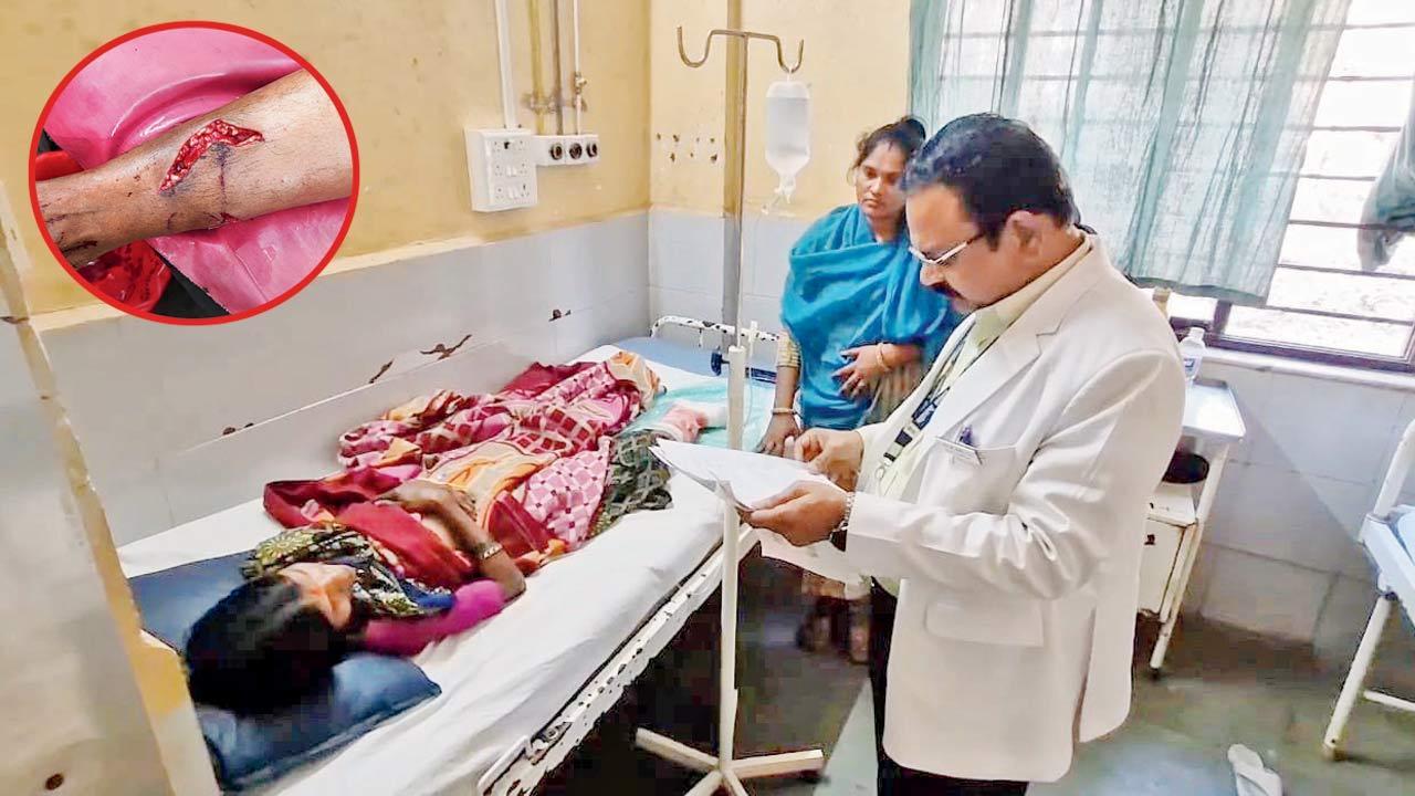 Ulhasnagar reports 135 dog bites in a day; 335 since Jan, and 21,411 in 2024